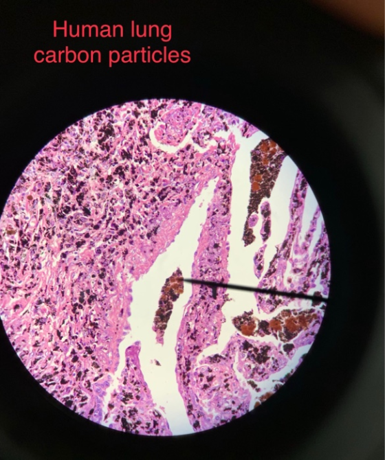Human lung carbon particles