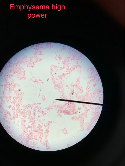 Emphysema high power