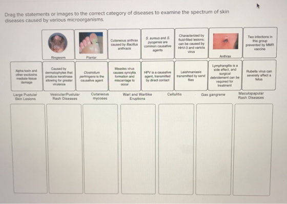 Drag the statements or images to the correct category of diseases to examine the spectrum of skin diseases caused by various microorganisms. Cutaneous anthrax Saureus and S Characterized by pyogenes are caused by Bcommon causative HHV-3 and variola Two infectons in this group prevented by MMR fluid-filled lesions can be caused by anthracis agents Anthrax Caused by Measles virus causes synoytia HPV is a causative Leishmaniasis miscarriage to by direct contact Alpha toxin and dermatophytes that side eflect, andRubella virus can mediate tissue produce keratinase allowing for greater surgical debridement can be required for treatment transmitted by sand flies severely affect a fetus agont, transmitted causative agent damage virulence Vesicular/Pustular Cutaneous Maculopapular Rash Diseases Cellulitis Large Pustular Skin Lesions Wart and Wartlike Eruptions Gas gangrene Rash Diseases mycoses