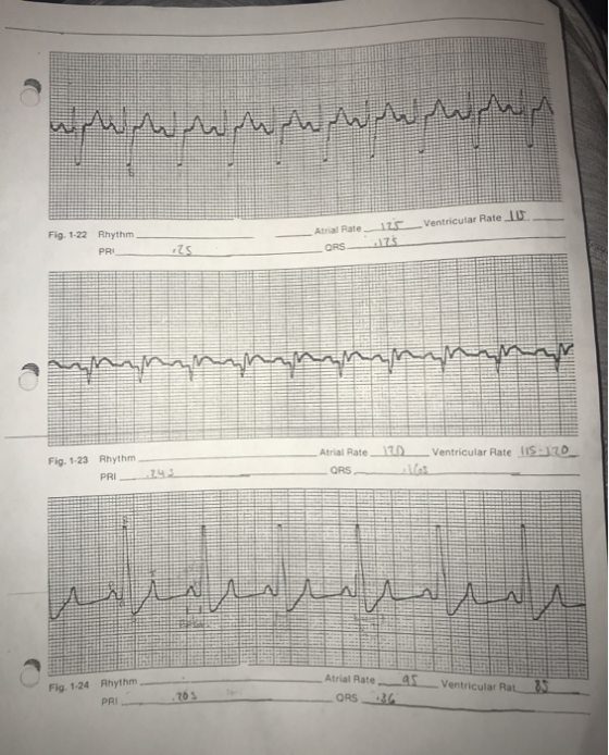 whenuhhhh Ventricular Rate U. Fig. 1-22 Rhythm PRI Atrial Rate_125_ ORS 17 25 annnnnnnnnnn Fig. 1-23 Rhythm PRI_-.242 Atrial