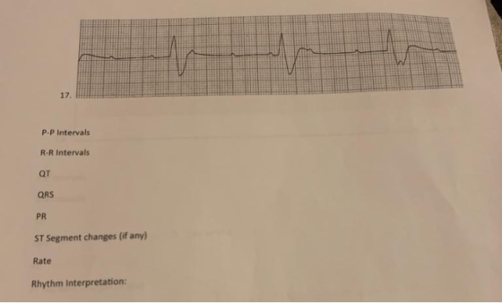 P.P Intervals R-R Intervals QT QRS PR ST Segment changes (if any) Rate Rhythm interpretation: