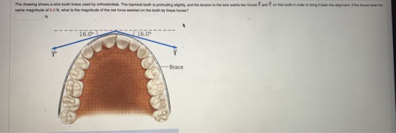 The drawing shows a wire tooth brace used by orthodontists. The topmost tooth is protruding slightly, and the tension in the