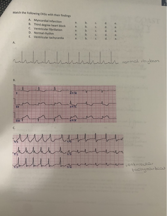 Match the following EKGs with their findings C A Myocardial infarction B. Third degree heart block Ventricular fibrillation D