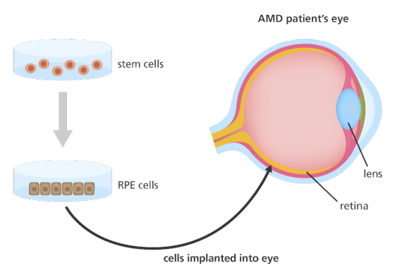 AMD patients eye O stem cells lens RPE cells retina cells implanted into eye