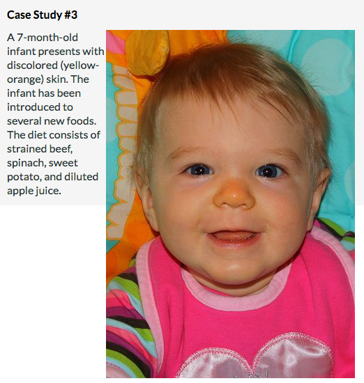 Case Study #3 A 7-month-old infant presents with discolored (yellow- orange) skin. The infant has been introduced to several