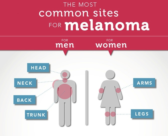 THE MOST common sites FoR melanoma FOR FOR men women HEAD NECK ARMS BACK TRUNK LEGS