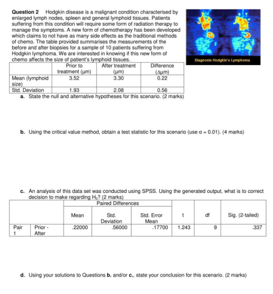 Question 2 Hodgkin disease is a malignant condition characterised by enlarged lymph nodes, spleen and general lymphoid tissues. Patients suffering from this condition will require some form of radiation therapy to manage the symptoms. A new form of chemotherapy has been developed which claims to not have as many side effects as the traditional methods of chemo. The table provided summarises the measurements of the before and after biopsies for a sample of 10 patients suffering from Hodgkin lymphoma. We are interested in knowing if this new form of chemo affects the size of patients l ymphoid tissues Diagnosis Hodgkins Lymphoma Prior to 3.52 1.93 After treatment 3.30 2.08 Difference 0.22 0.56 treatment Mean (lymphoid size Std. Deviation a. State the null and alternative hypotheses for this scenario. (2 marks) b. Using the critical value method, obtain a test statistic for this scenario (use a 0.01). (4 marks) c. An analysis of this data set was conducted using SPSS. Using the generated output, what is to correct decision to make regardin g Ho? (2 marks) Paired Differences Mean Std Deviation Std. Error Mean Sig. (2-tailed) df Pair Prior - 22000 56000 177001.243 337 After d. Using your solutions to Questions b. and/or c., state your conclusion for this scenario. (2 marks)