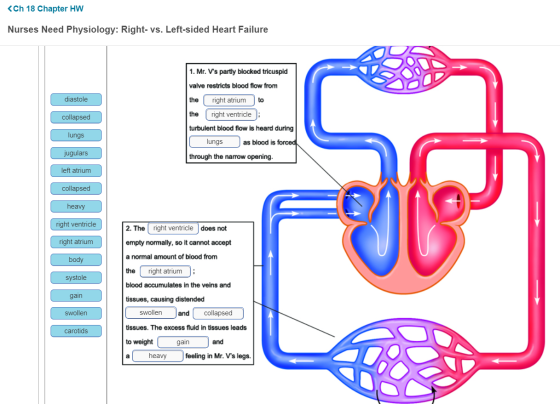 <Ch 18 Chapter HW Nurses Need Physiology: Right- vs. Left-sided Heart Failure diastole collapsed 1. Mr. Vs partly blocked tr