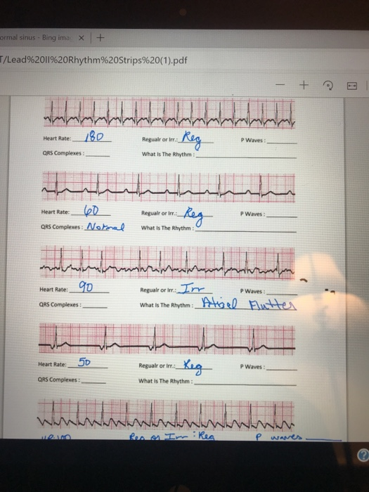 ormal sinus - Bing imac x + T/Lead%2011%20Rhythm%20Strips%20(1).pdf - + Heart Rate :_180 QRS Complexes Regualr or irr: Rec P