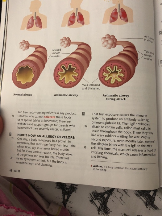 Air trappe in alvedi Relaxed smooth muscles muscles Wall inflamed and thickened Asthmatic airway during attack Asthmatic airw