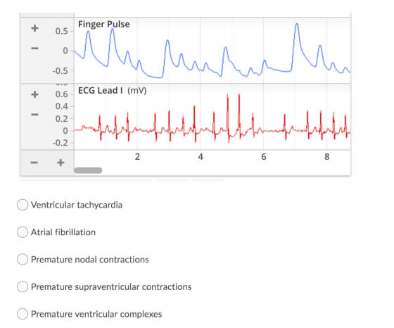 Finger Pulse + | -0.5 - Minhanh s elatah boleh belindustry | + 6. ECG Lead I (mv) 0.4 | 0.2 -0.2 | | 4 6 O Ventricular tachyc