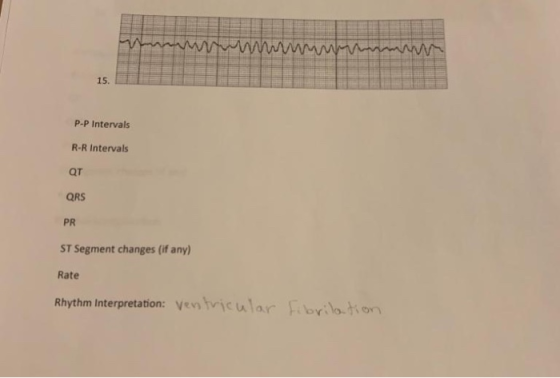 ww 15. P-P Intervals R-R Intervals QT QRS PR ST Segment changes (if any) Rate Rhythm Interpretation: Ve tricular Fibrilotion