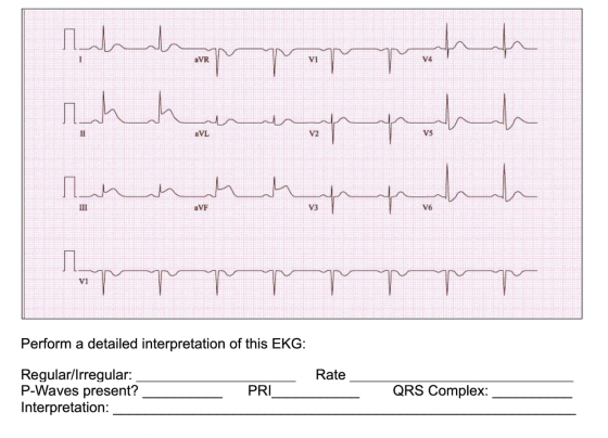 aVR apart لا لا مرارا الله للطلا pppppp Perform a detailed interpretation of this EKG: Rate Regular/Irregular: P-Waves presen