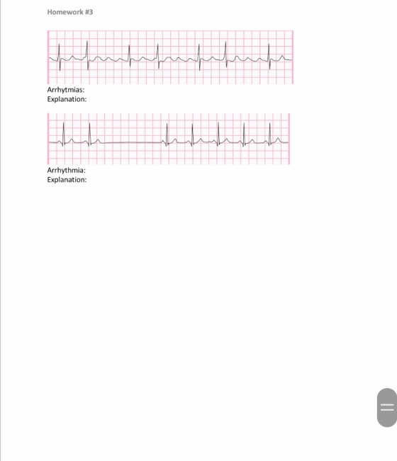 Homework #3 Arrhytmias: Explanation: hawanan Arrhythmia: Explanation:
