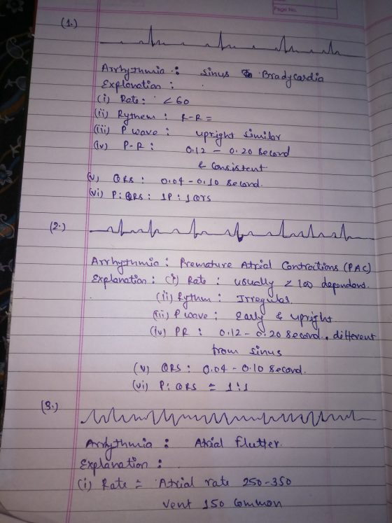 Page No. والیبالملممملم Arrhythmia: sinus for Brady cardia Explonation : (i) Rate: 260 i Rythem : R-R= (ii) P wave i upright