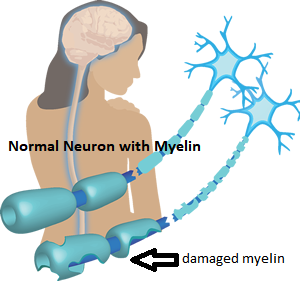 Normal Neuron with Myelin damaged myelin
