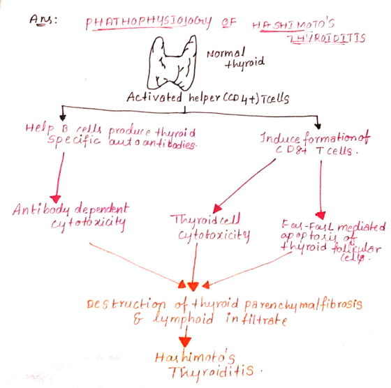 Ans: HA SHIMOTOs IROIDITIS PHATHOPHYSI0100ry OF Normal thyroid Activoted helper CCD 4+) Tcells Help B cella produte thyroi d