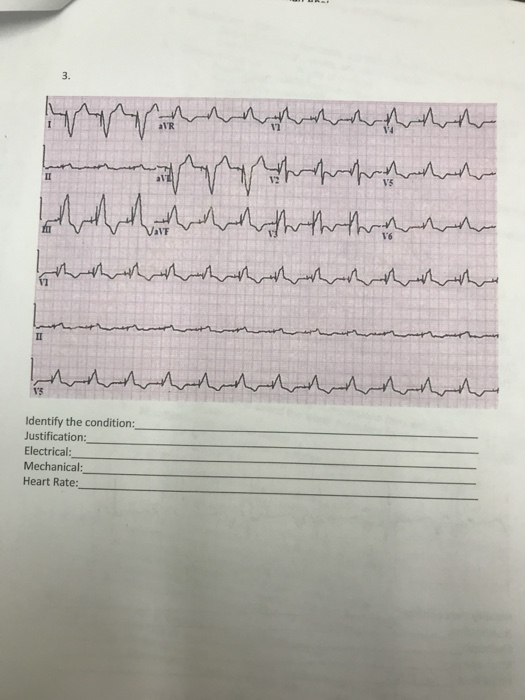 3. aVR Vs aVF V6 1s Identify the condition: Justification Electrical Mechanical: Heart Rate: