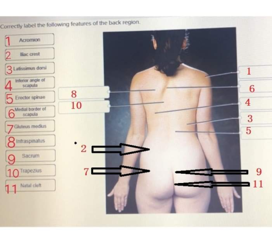 Correctly label the following features of the back region 1 Acromion 2 liac crest 3 Latissimus dorsi Interior angle of scapul
