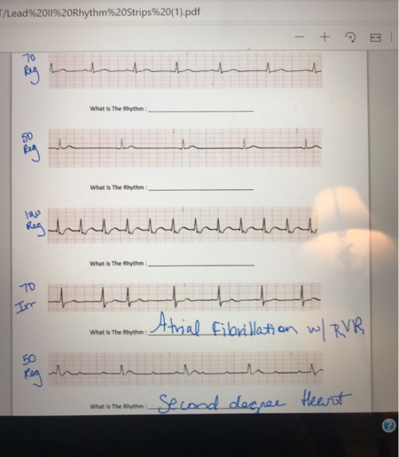 T/Lead%2011%20Rhythm%20Strips%20(1).pdf - + E What Is The Rhythm What Is The Rhythm: lo hay understandartamente What Is The R