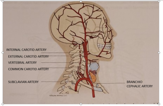 INTERNAL CAROTID ARTERY EXTERNAL CAROTID ARTERY VERTEBRAL ARTERY COMMON CAROTID ARTERY SUBCLAVIAN ARTERY BRANCHIO CEPHALIC AR