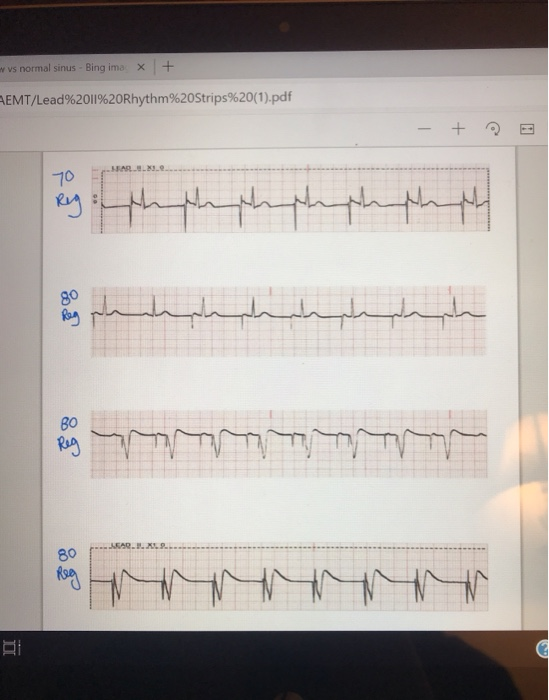 vvs normal sinus - Bing ima X + REMT/Lead%2011%20Rhythm%20Strips%20(1).pdf سلام امام العام المال: وه لمسلسل ليلى المهلهلم و N