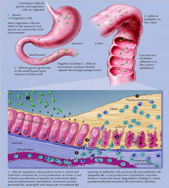 Clostridium difficile spores and vegetative cells are ingested • Spores Vegetative cells Most vegetative cells are killed in