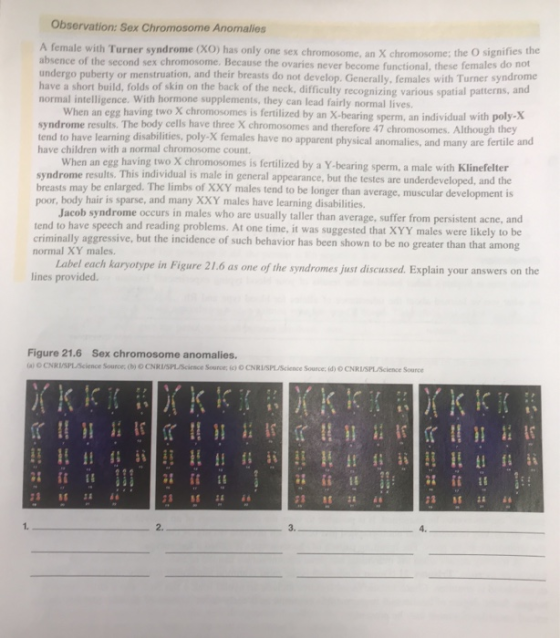 Observation: Sex Chromosome Anomalies A female with Turner syndrome (XO) has only one sex chromosome, an X chromosome; the O