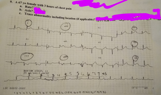 9. A 67 yo female with 3 hours of chest pain a. Rate? b. Axis? c. Trace abnormality including location (if applicable)? uhumm