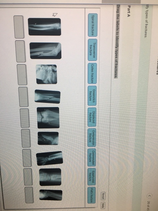 26 of 45 y types of fractures Part A ssion seal Spiral fracture fracture Greenstick re L3
