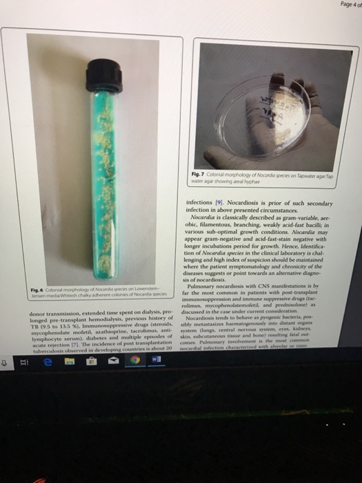 Page 4 of Fig.7 Colonial morphology of Nocandia species on Tapwater agar Tap water agar showing areal hyphae infections [9). Nocardiosis is prior of such secondary infection in above presented circumstances. Nocardia is classically described as gram-variable, aer- obic, filamentous, branching, weakly acid-fast bacil; in various sub-optimal growth conditions. Nocardia may appear gram-negative and acid-fast-stain negative with longer incubations period for growth Hence, Identifica tion of Nocardia species in the clinical laboratory is chal lenging and high index of suspicion should be maintained where the patient symptomatology and chronicity of the diseases suggests or point towards an alternative diagno- sis of nocardiosis. Pulmonary nocardiosis with CNS manifestations is by Fig.6 Colonial morphology of Nocandid species on Lowenstein- ensen mediaWhtesh chalky adherent olonies of Nocardia speciesfar the most common in patients with post-transplant and immune suppressive drugs (tac- mycophenolatemofetil and predaisolone) as donor transmission, extended time spent on dialysis, pro discussed in the case under current consideration transplant hemodialysis, previous history of Nocardiosis tends to behave as pyogenic bacteria, pos- TB (9.5 to 13.5 %). Immunosuppressive drugs (steroids, sibly metastasizes haensaeogrnouly into mycophenolate mofetil, azathioprine, tacrolimus, anti system (langs, central nervous system eyes. kidacys lymphocyte liabetes and maltiple episodes of skin, subcutaneous tissue and bone) resalring fatal out 1. The incidence of post transplantation comes. Pulmonary involvement is the most