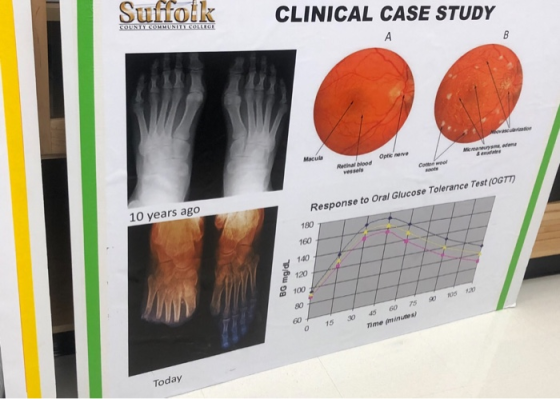 CLINICAL CASE STUDY COUNTY COMMUNITY COLLEGE А Retinal blood Coro Response to Oral Glucose Tolerance Test (OGTT) 10 years ago