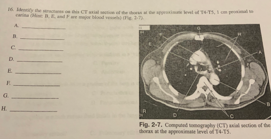 16. Identify the structures on this CT axial section of the thorax at the approximate level of T4-T5, 1 cm proximal to carina (Hint: B, E, and F are major blood vessels) (Fig. 2-7). A. L1 B. C. D. E. G. Fig. 2-7. Computed tomography (CT) axial section of the thorax at the approximate level of T4-T5