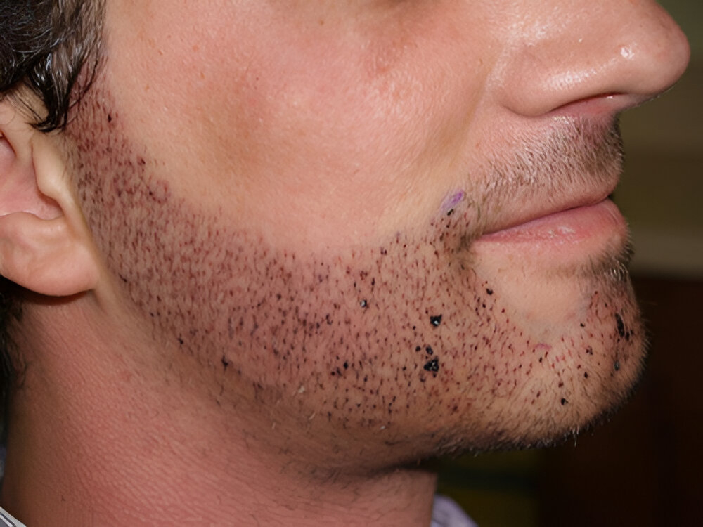 1771239376397030.jpg beard transplant.jpg