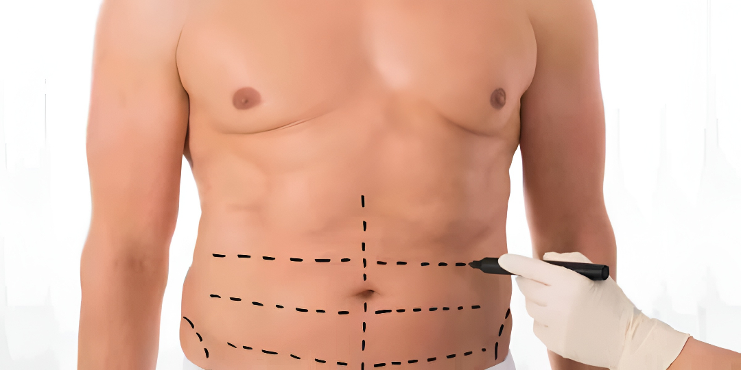 1773728162934307.jpg Liposuction Surgery.jpg